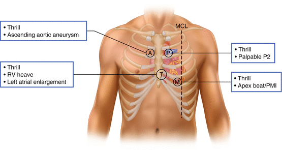 Introduction To Cardiac Auscultation Thoracic Key