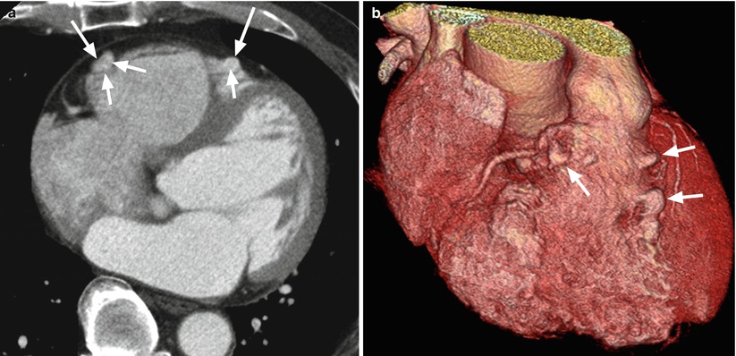 Acute Myocarditis and Other Cardiomyopathies Thoracic Key