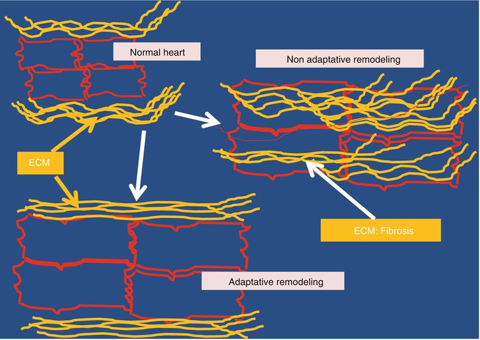 Gene Therapy For The Heart | Thoracic Key