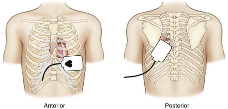 anterior posterior pads position electrical therapy combination figure