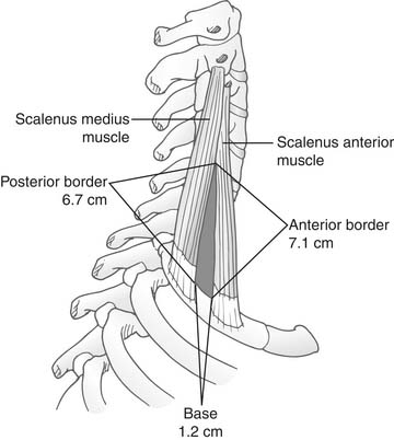 Thoracic Outlet Syndrome and Dorsal Sympathectomy | Thoracic Key