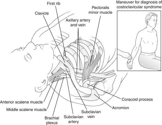 Thoracic Outlet Syndrome and Dorsal Sympathectomy