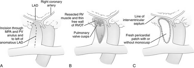 Tetralogy Of Fallot With Pulmonary Stenosis | Thoracic Key