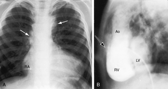 Double Outlet Ventricle | Thoracic Key