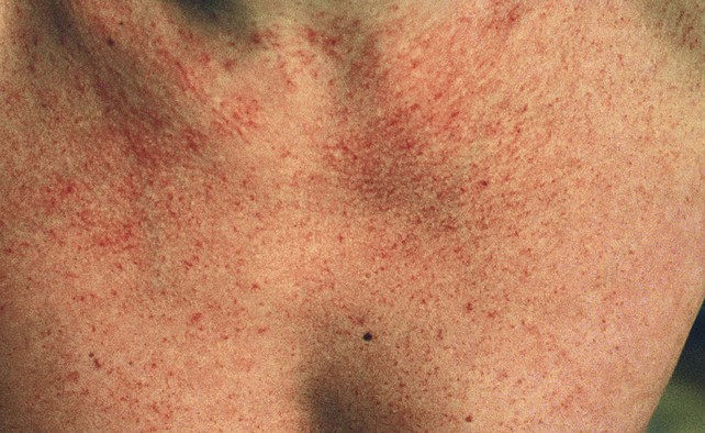 telangiectasia chest