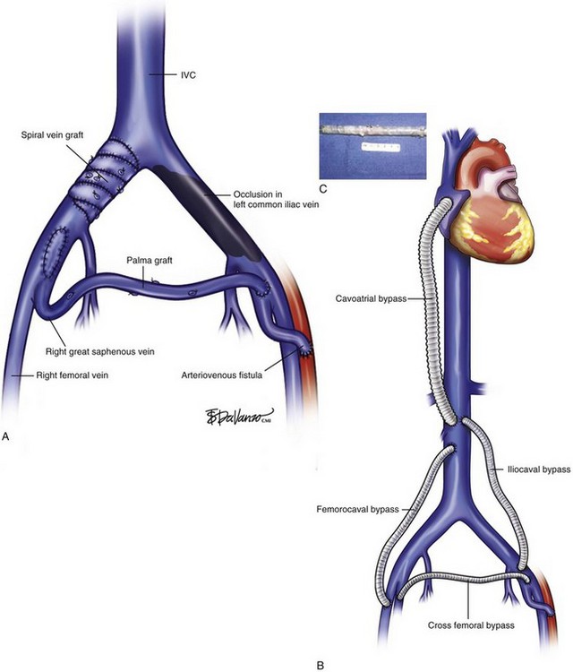 Femoral Bypass