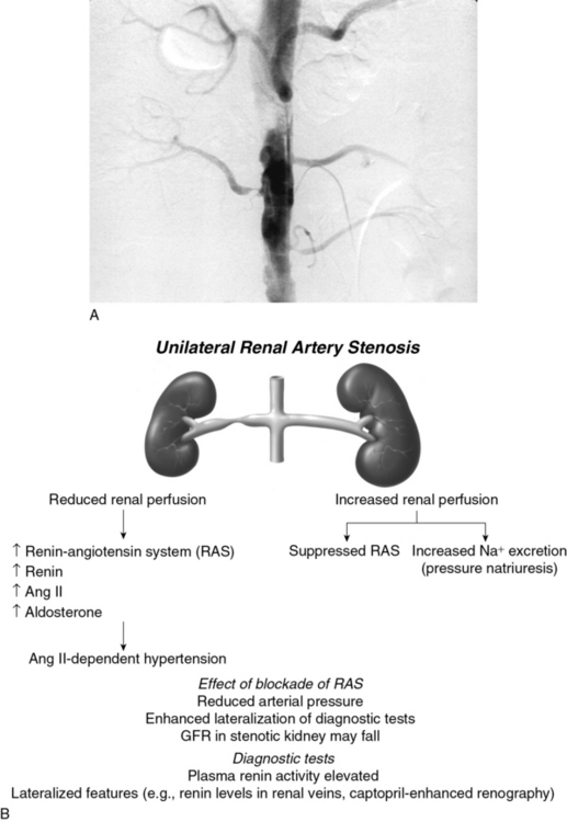 Renal Artery Stenosis Pathophysiology