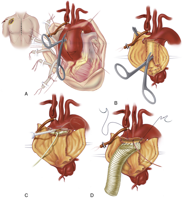 Surgical Therapy For Aortic Dissection Thoracic Key