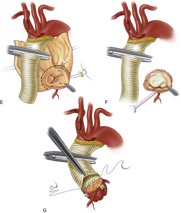 Surgical Therapy for Aortic Dissection  Thoracic Key