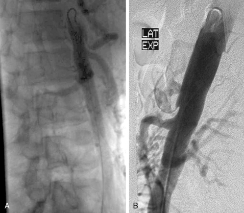 Vascular Compression Syndromes | Thoracic Key