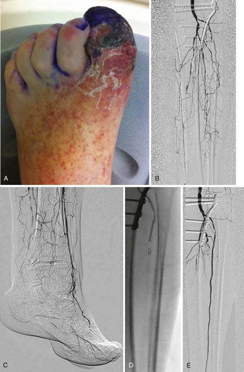 Endovascular Therapy for Infrapopliteal Arterial Occlusive Disease