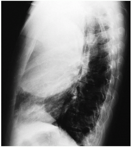 Nonseminomatous Germ Cell Tumor Thoracic Key