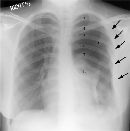 Rib Fracture Pneumothorax