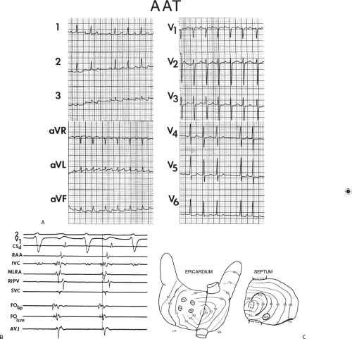cpt code of atrial flutter ablation