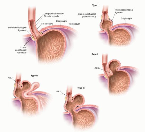 Paraesophageal Hernia Repair Laparoscopic Technique Thoracic Key