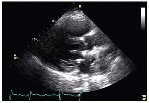 Mitral Valve Repair for Mitral Regurgitation | Thoracic Key