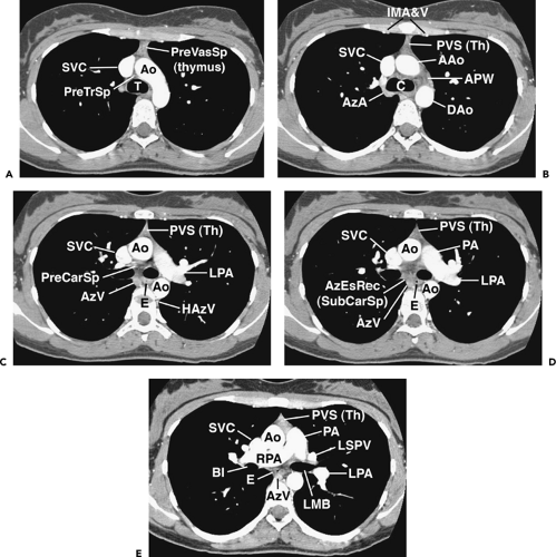 mediastinum-thoracic-key