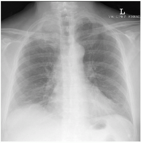 Pancoast’s Tumor | Thoracic Key