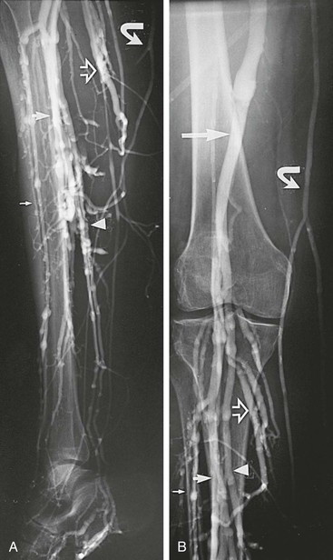 Venography Thoracic Key 