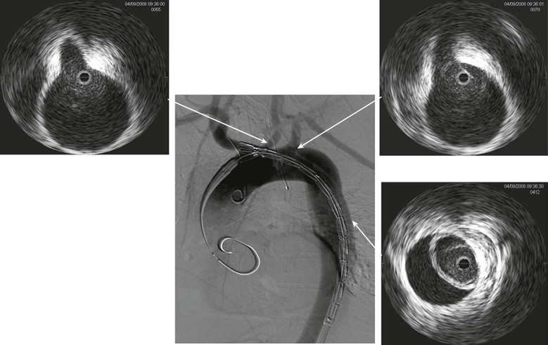 Intravascular Ultrasound | Thoracic Key