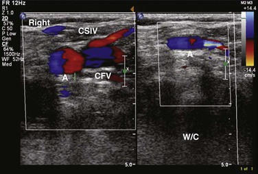 Acute Deep Venous Thrombosis | Thoracic Key