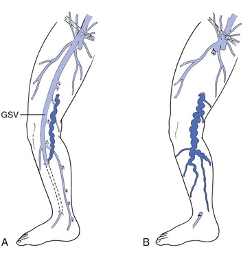 Varicose Veins : Mark O'Donnell Vascular Surgery