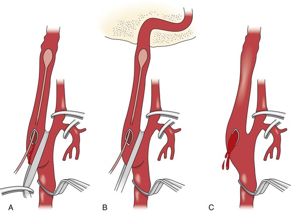 pressure on carotid artery