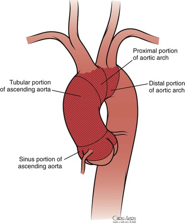 transverse arch aorta
