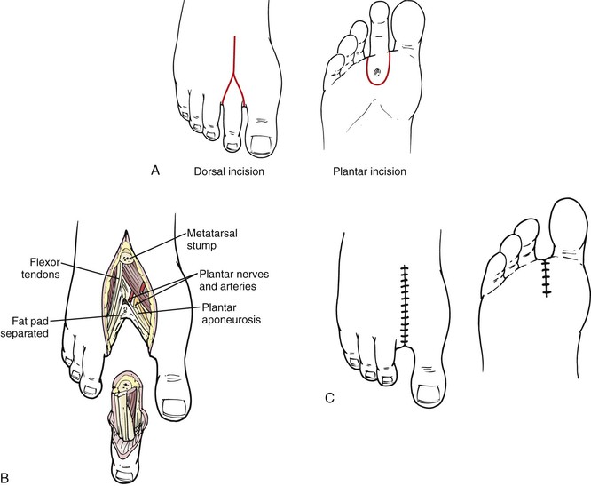 tarsometatarsal amputation