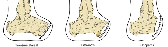 tarsometatarsal amputation