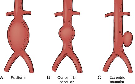 Blood Thinners and Aneurysms : Cardiology