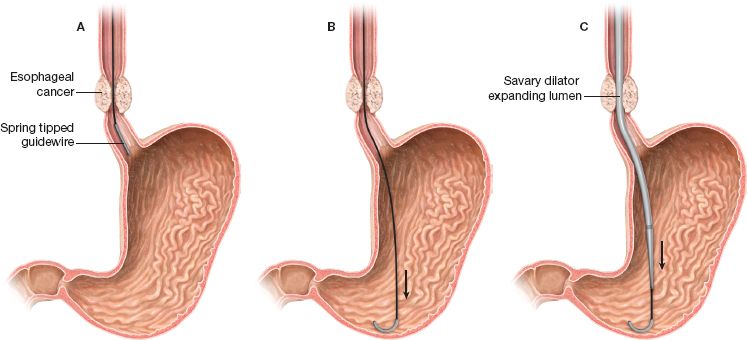 bougie-and-balloon-dilation-of-esophageal-strictures-malignant-and