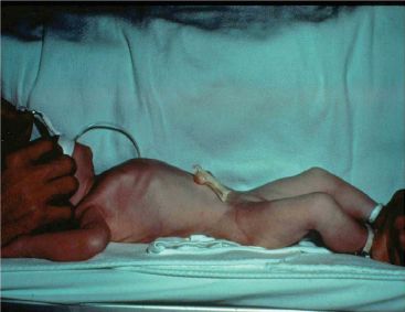 scaphoid abdomen newborn