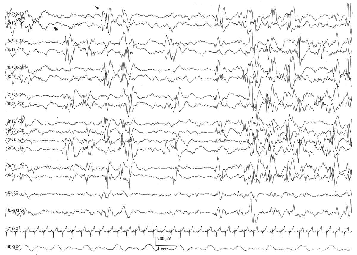 Normal Pediatric EEG: Neonates and Children | Thoracic Key