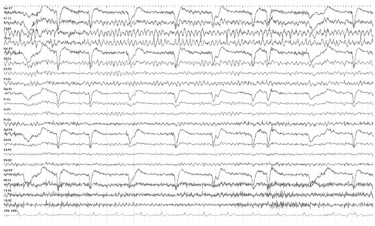 EEG in Focal Encephalopathies: Cerebrovascular Disease, Neoplasms, and ...