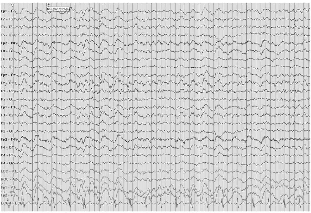 EEG in Focal Encephalopathies: Cerebrovascular Disease, Neoplasms, and