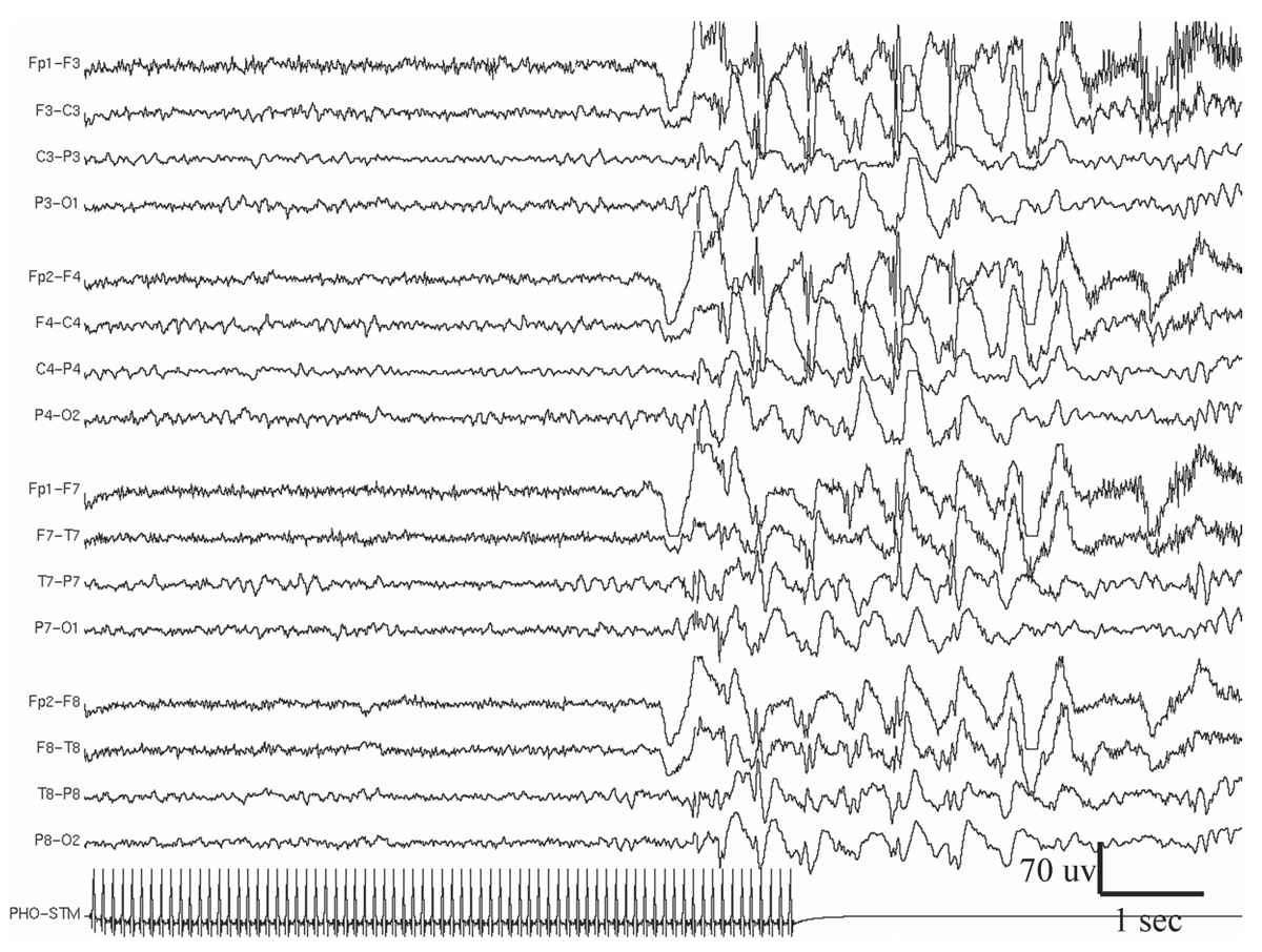 EEG in Adult Epilepsy | Thoracic Key