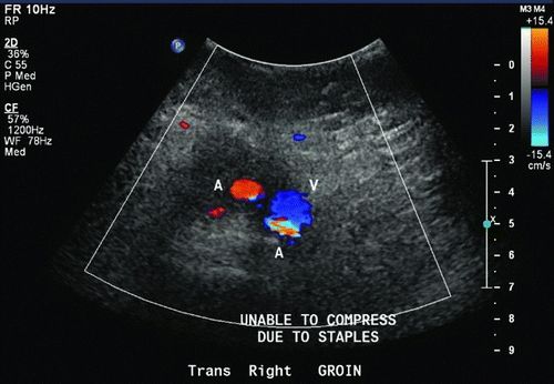 Groin Hematoma Ultrasound