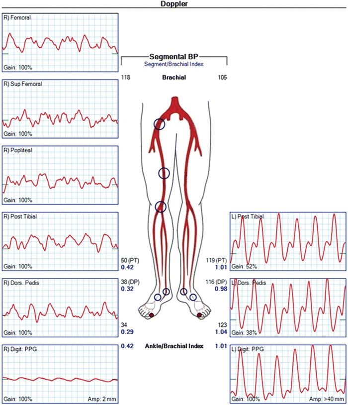 Acute Left Leg Ischemia Icd 10