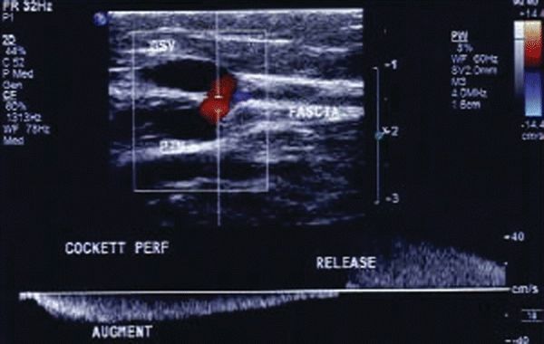 Incompetent Venous Perforators | Thoracic Key