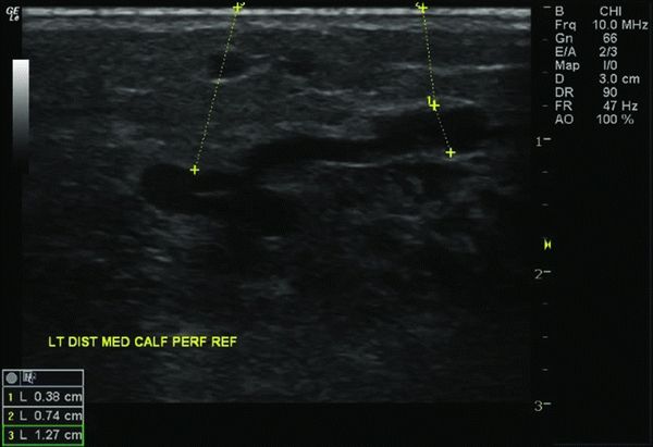 Incompetent Venous Perforators | Thoracic Key