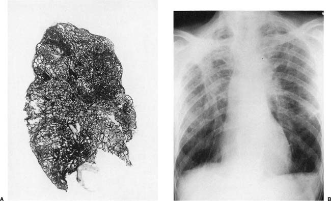 Mica pneumoconiosis: a neglected occupational lung disease - The Lancet  Respiratory Medicine