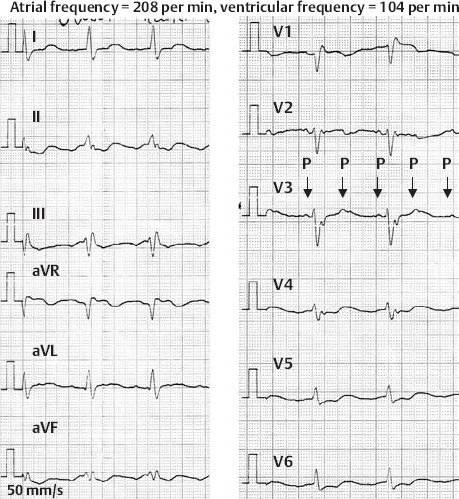 atypical atrial flutter