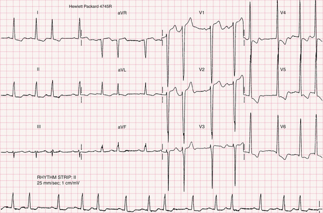 Supraventricular rhythms | Thoracic Key