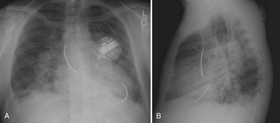 Arrhythmias And Adult Congenital Heart Disease | Thoracic Key