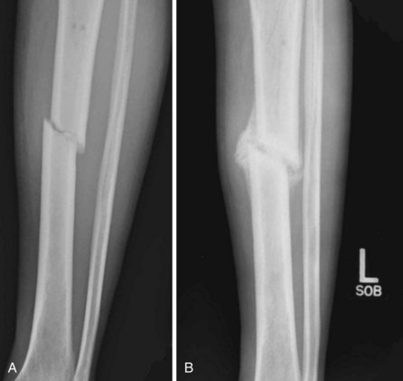 Emergency Care Of Musculoskeletal Injuries Thoracic Key