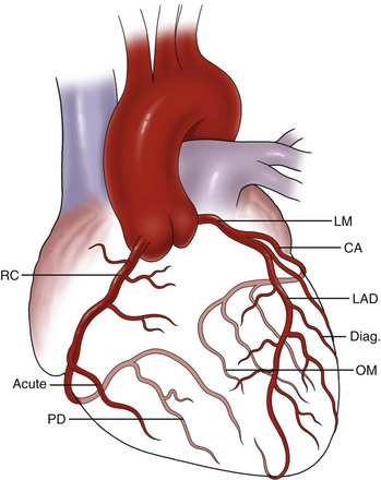 Acquired Heart Disease: Coronary Insufficiency | Thoracic Key