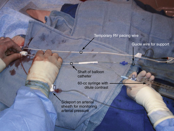 Aortic and Pulmonic Balloon Valvuloplasty | Thoracic Key