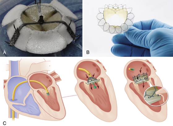 Percutaneous Approach To Pericardial Window | Thoracic Key