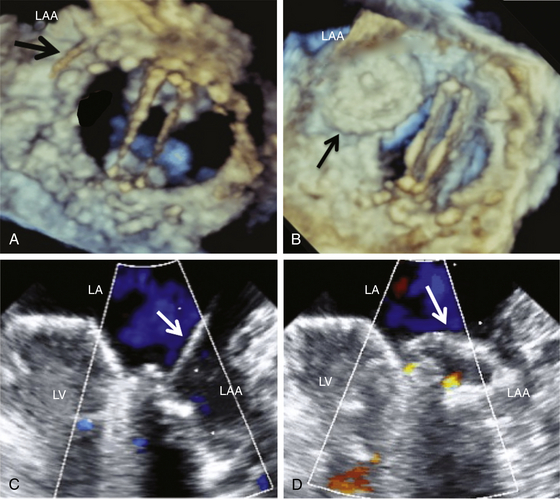 Percutaneous Repair of Paravalvular Leaks | Thoracic Key